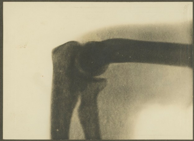 x-ray, elbow 1900, Melbourne