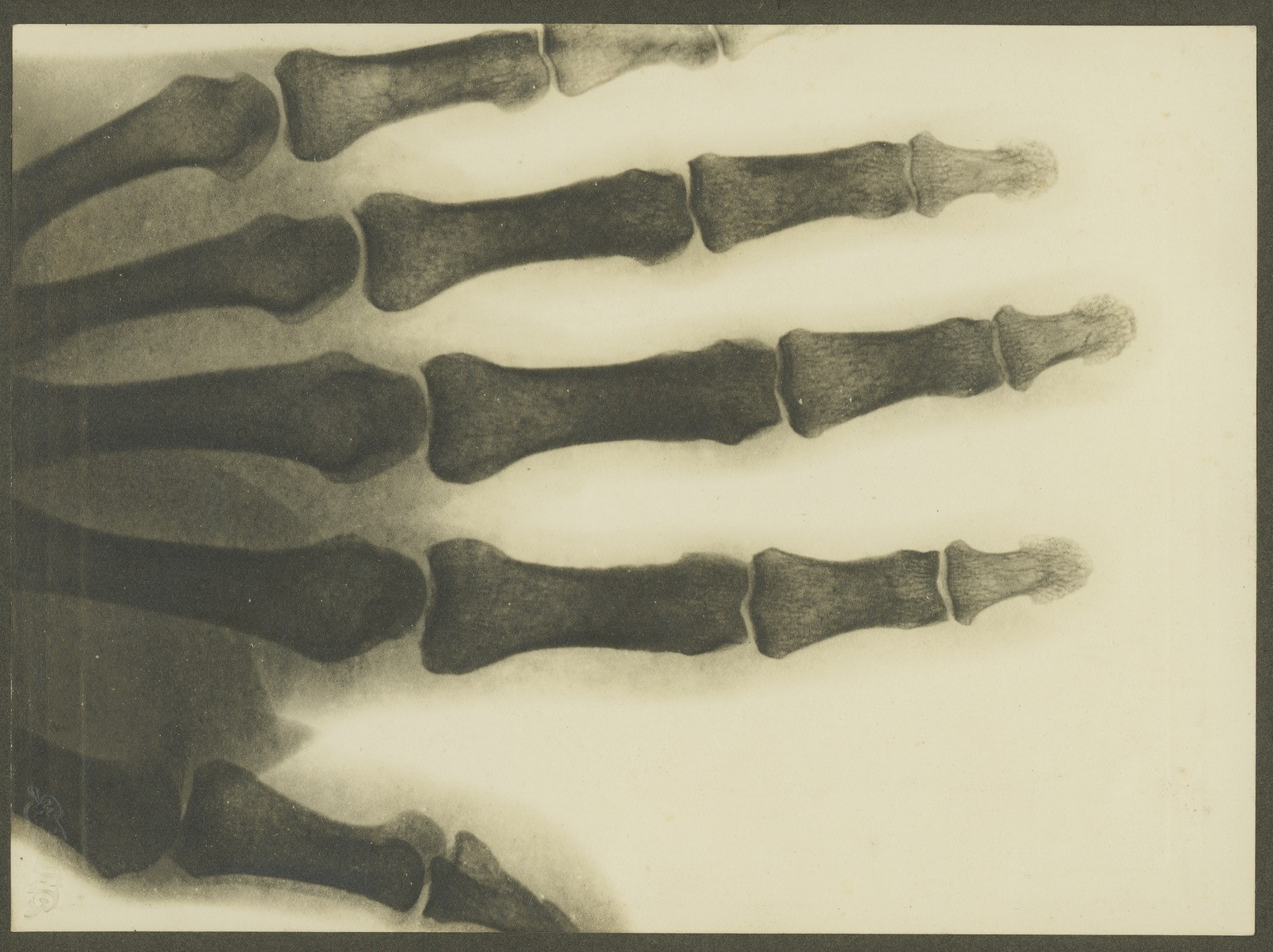 x-ray hand about 1900