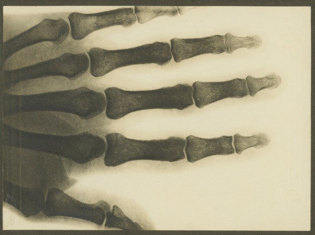 x-ray hand about 1900